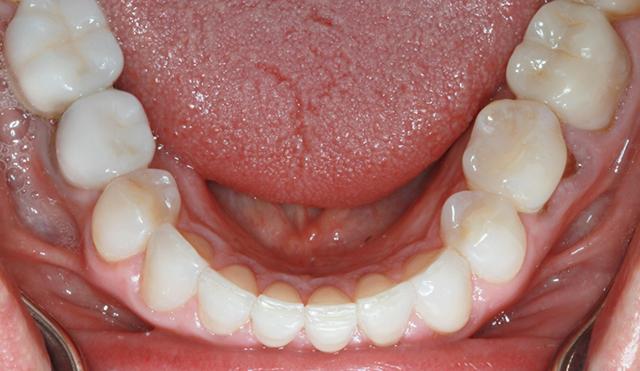 Invisalign after at Nashville Restorative Dentistry in Franklin, TN
