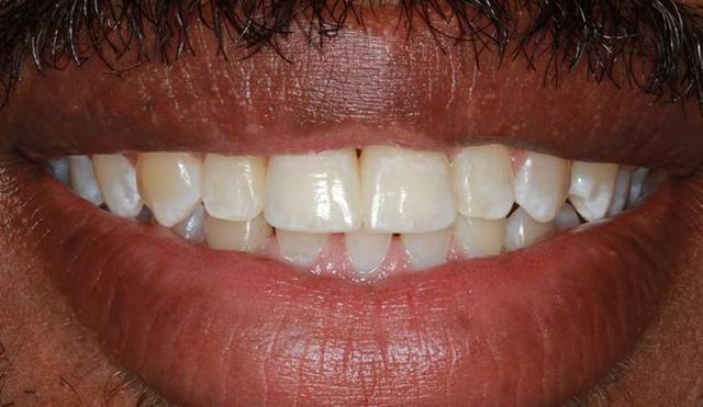Invisalign after at Nashville Restorative Dentistry in Franklin, TN