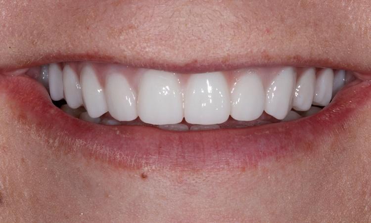 Nashville Restorative Dentistry smile makeover after — Franklin, TN