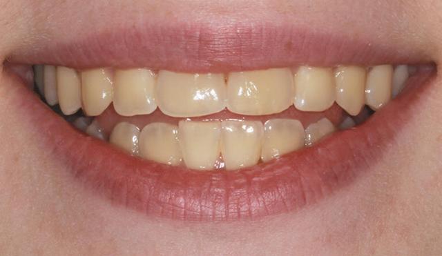 Invisalign before at Nashville Restorative Dentistry in Franklin, TN
