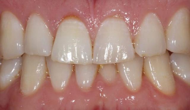 Teeth Whitening after at Nashville Restorative Dentistry in Franklin, TN