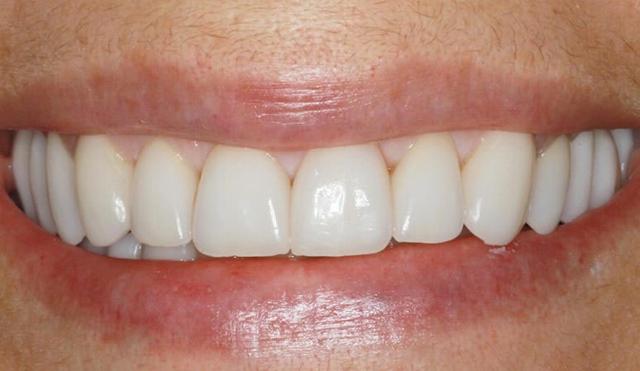 Dental Veneers after at Nashville Restorative Dentistry in Franklin, TN