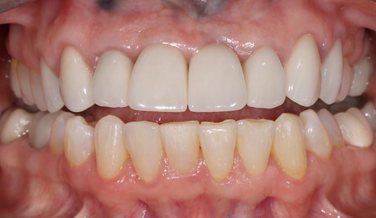 Nashville Restorative Dentistry dental implants after — Franklin, TN