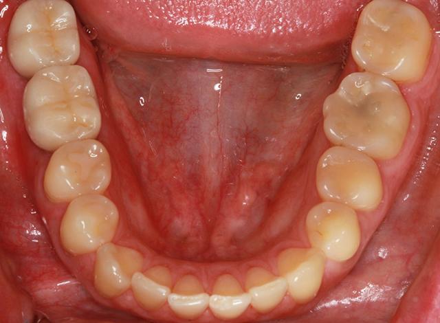Dental Implants after at Nashville Restorative Dentistry in Franklin, TN