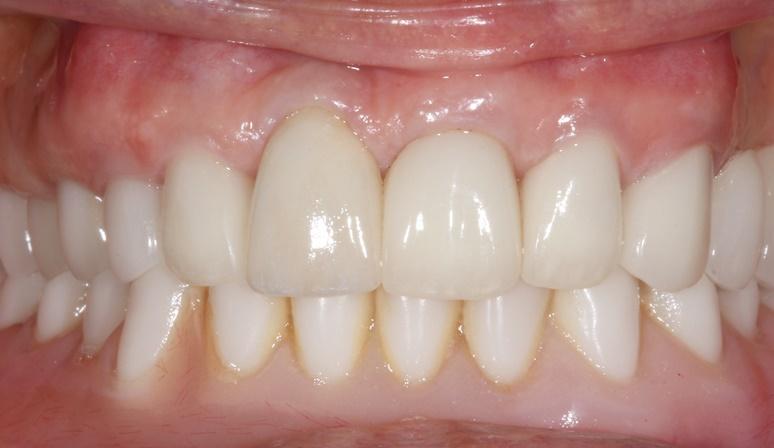 Nashville Restorative Dentistry smile makeover after — Franklin, TN