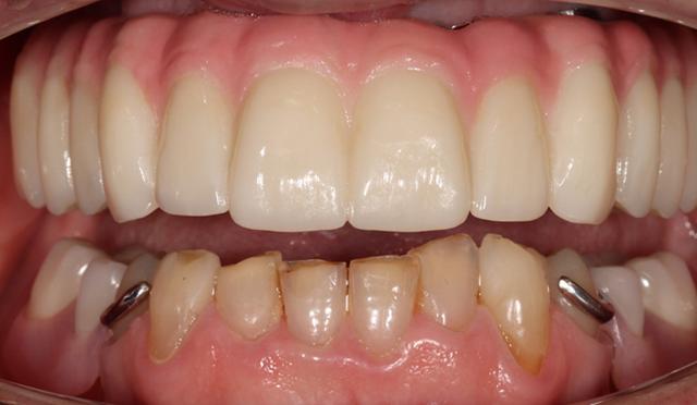 Dental Implants after at Nashville Restorative Dentistry in Franklin, TN