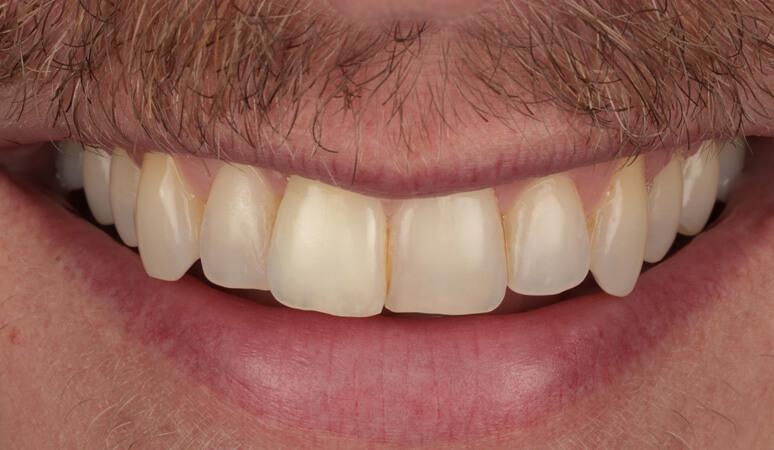 Nashville Restorative Dentistry teeth whitening after — Franklin, TN