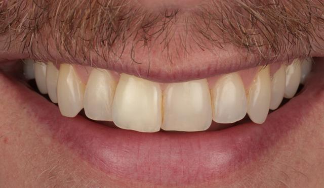 Teeth Whitening after at Nashville Restorative Dentistry in Franklin, TN