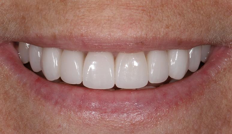 Nashville Restorative Dentistry veneers after — Franklin, TN