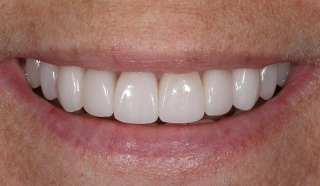 Dental Veneers after at Nashville Restorative Dentistry in Franklin, TN