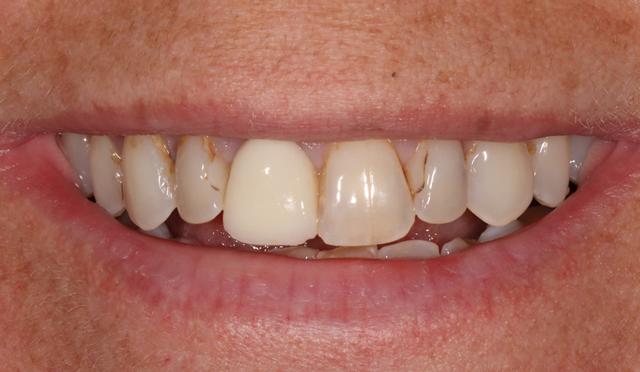 Dental Veneers before at Nashville Restorative Dentistry in Franklin, TN