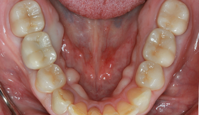 Nashville Restorative Dentistry smile makeover after — Franklin, TN