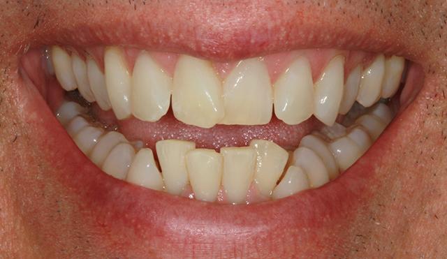 Invisalign before at Nashville Restorative Dentistry in Franklin, TN