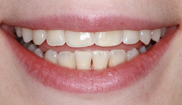 Nashville Restorative Dentistry teeth whitening after — Franklin, TN