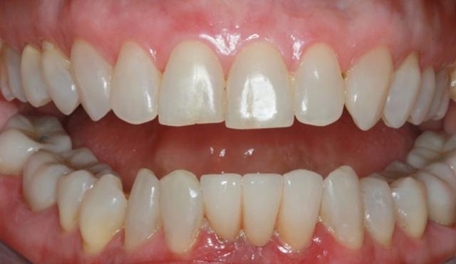 Smile Makeover after at Nashville Restorative Dentistry in Franklin, TN