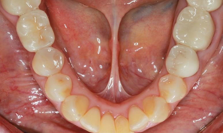 Nashville Restorative Dentistry smile makeover after — Franklin, TN