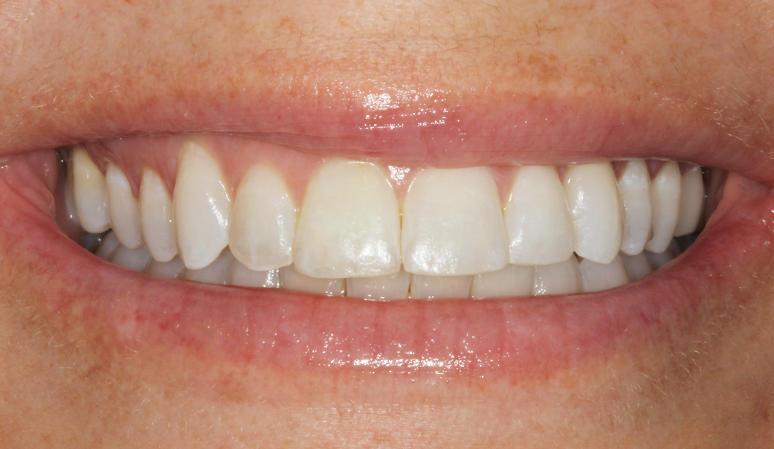 Nashville Restorative Dentistry teeth whitening after — Franklin, TN