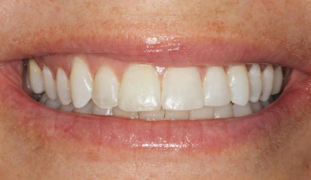 Teeth Whitening after at Nashville Restorative Dentistry in Franklin, TN