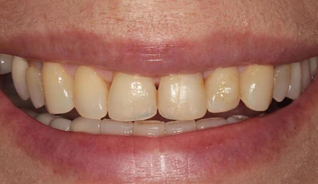 Dental Veneers before at Nashville Restorative Dentistry in Franklin, TN