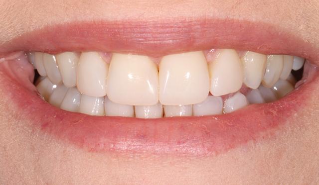 Dental Veneers after at Nashville Restorative Dentistry in Franklin, TN