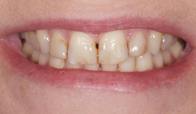 Dental Veneers before at Nashville Restorative Dentistry in Franklin, TN