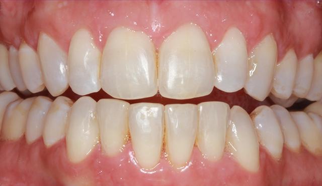 Invisalign after at Nashville Restorative Dentistry in Franklin, TN