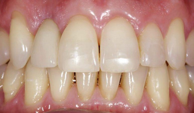Nashville Restorative Dentistry smile makeover after — Franklin, TN