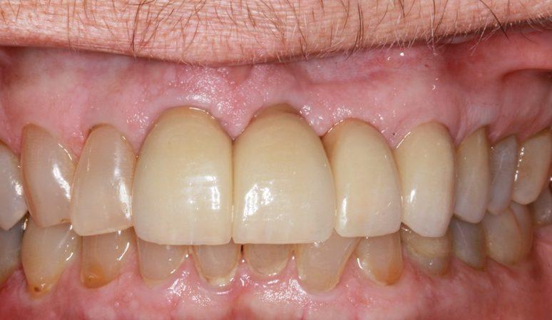Nashville Restorative Dentistry smile makeover after — Franklin, TN