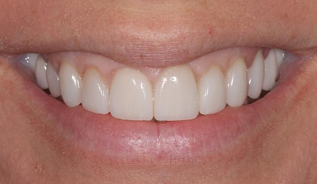 Dental Veneers after at Nashville Restorative Dentistry in Franklin, TN