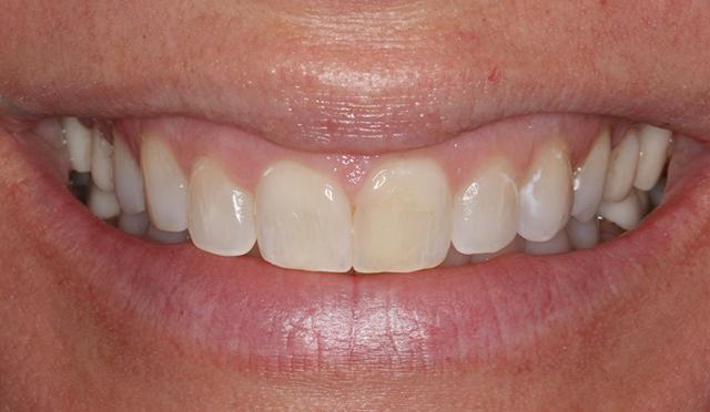 Dental Veneers before at Nashville Restorative Dentistry in Franklin, TN