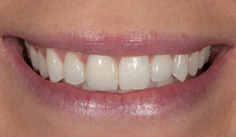 Nashville Restorative Dentistry veneers after — Franklin, TN