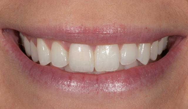 Dental Veneers after at Nashville Restorative Dentistry in Franklin, TN