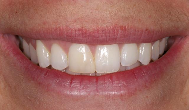 Dental Veneers before at Nashville Restorative Dentistry in Franklin, TN