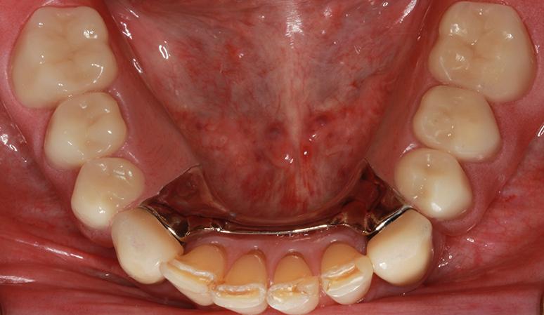 Nashville Restorative Dentistry smile makeover after — Franklin, TN