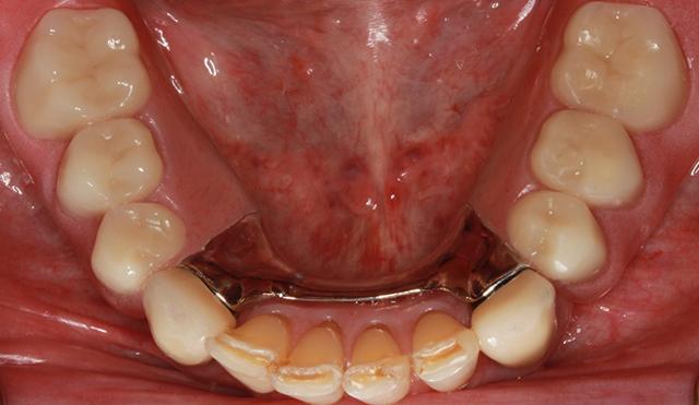 Smile Makeover after at Nashville Restorative Dentistry in Franklin, TN