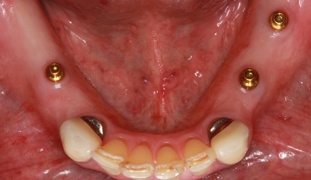 Smile Makeover before at Nashville Restorative Dentistry in Franklin, TN