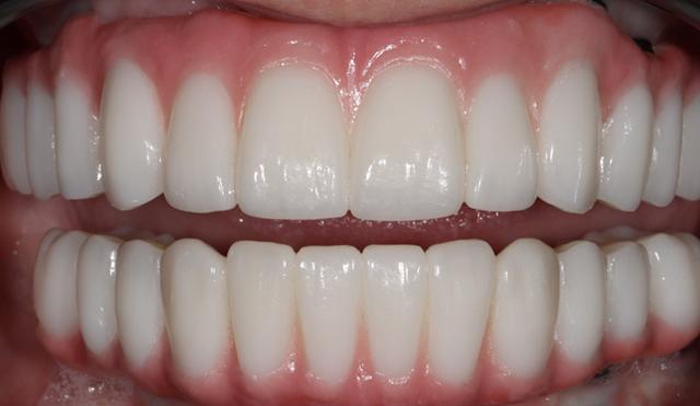Dental Implants after at Nashville Restorative Dentistry in Franklin, TN