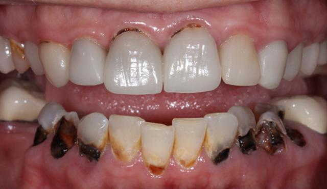 Dental Implants before at Nashville Restorative Dentistry in Franklin, TN