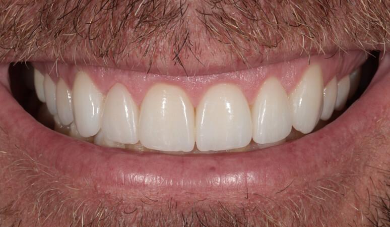 Nashville Restorative Dentistry veneers after — Franklin, TN