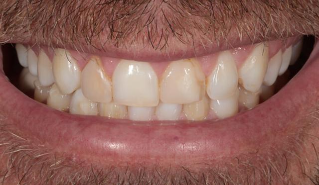 Dental Veneers before at Nashville Restorative Dentistry in Franklin, TN