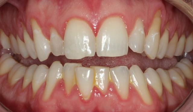 Invisalign after at Nashville Restorative Dentistry in Franklin, TN