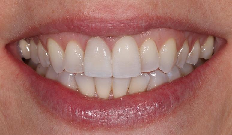 Nashville Restorative Dentistry veneers after — Franklin, TN
