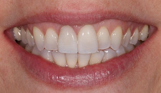 Dental Veneers after at Nashville Restorative Dentistry in Franklin, TN