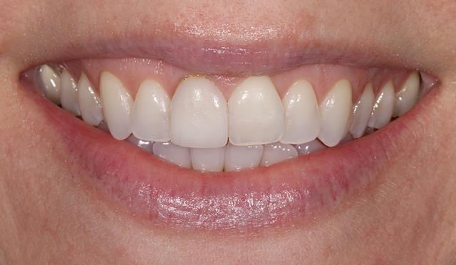Dental Veneers before at Nashville Restorative Dentistry in Franklin, TN