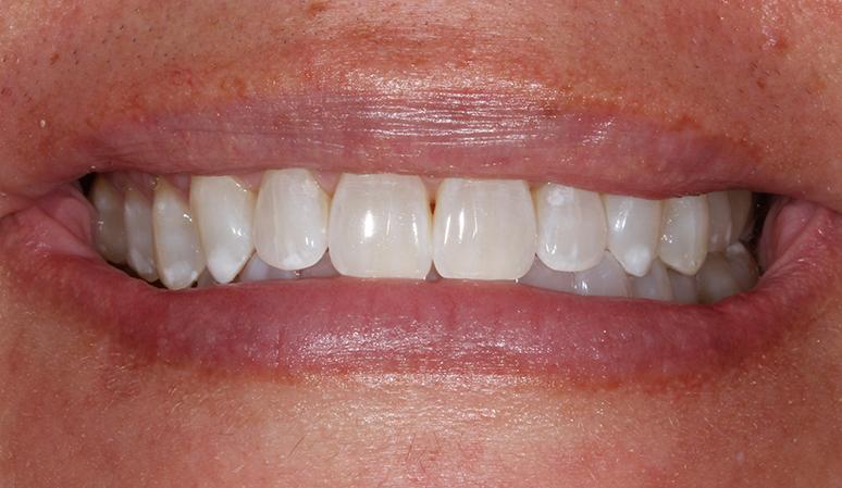 Nashville Restorative Dentistry teeth whitening after — Franklin, TN