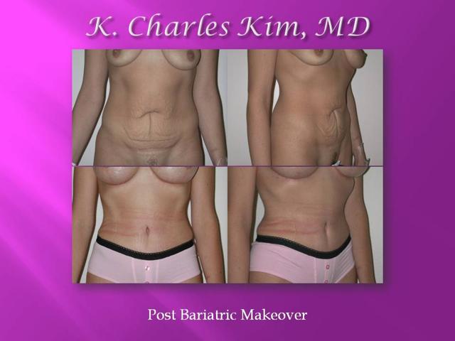 Tummy Tuck result at CK Plastic Surgery in Los Angeles, CA