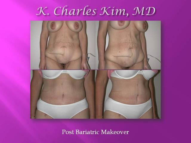 Tummy Tuck result at CK Plastic Surgery in Los Angeles, CA