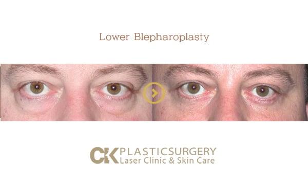 CK Plastic Surgery blepharoplasty result — Los Angeles, CA