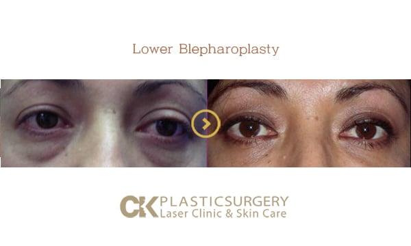CK Plastic Surgery blepharoplasty result — Los Angeles, CA