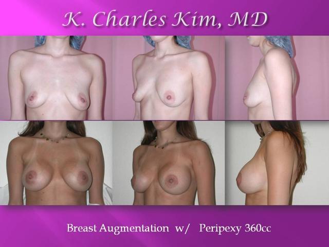 Tummy Tuck result at CK Plastic Surgery in Los Angeles, CA